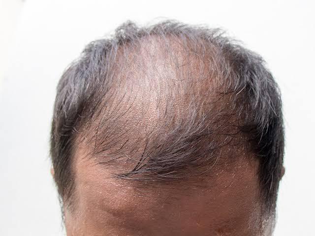 Common Mistakes People Make When Using Minoxidil (and How to Avoid Them)