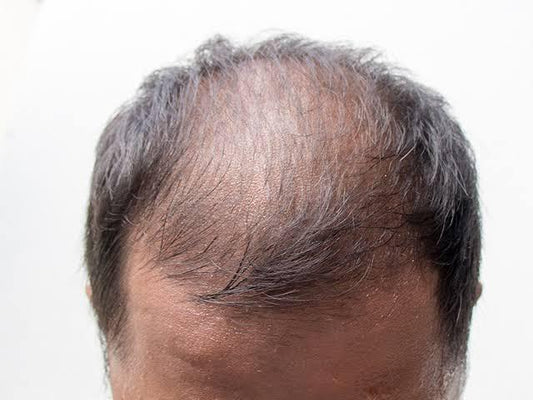 Common Mistakes People Make When Using Minoxidil (and How to Avoid Them)